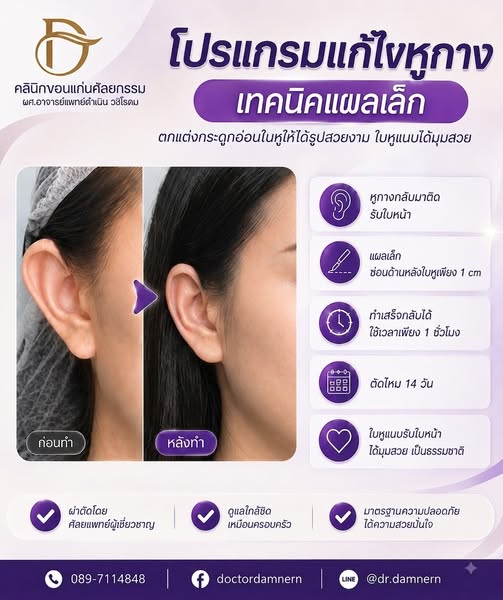 โปรแกรมแก้ไขหูกางเทคนิคแผลเล็ก แผลซ่อนหลังใบหูเพียง 1 ซม. ใช้เวลาผ่าตัดประมาณ 1 ชั่วโมง ตัดไหม 14 วัน คลินิกขอนแก่นศัลยกรรม